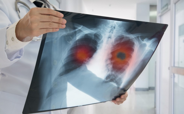 Cancerul pulmonar: cauze, simptome și opțiuni de tratament